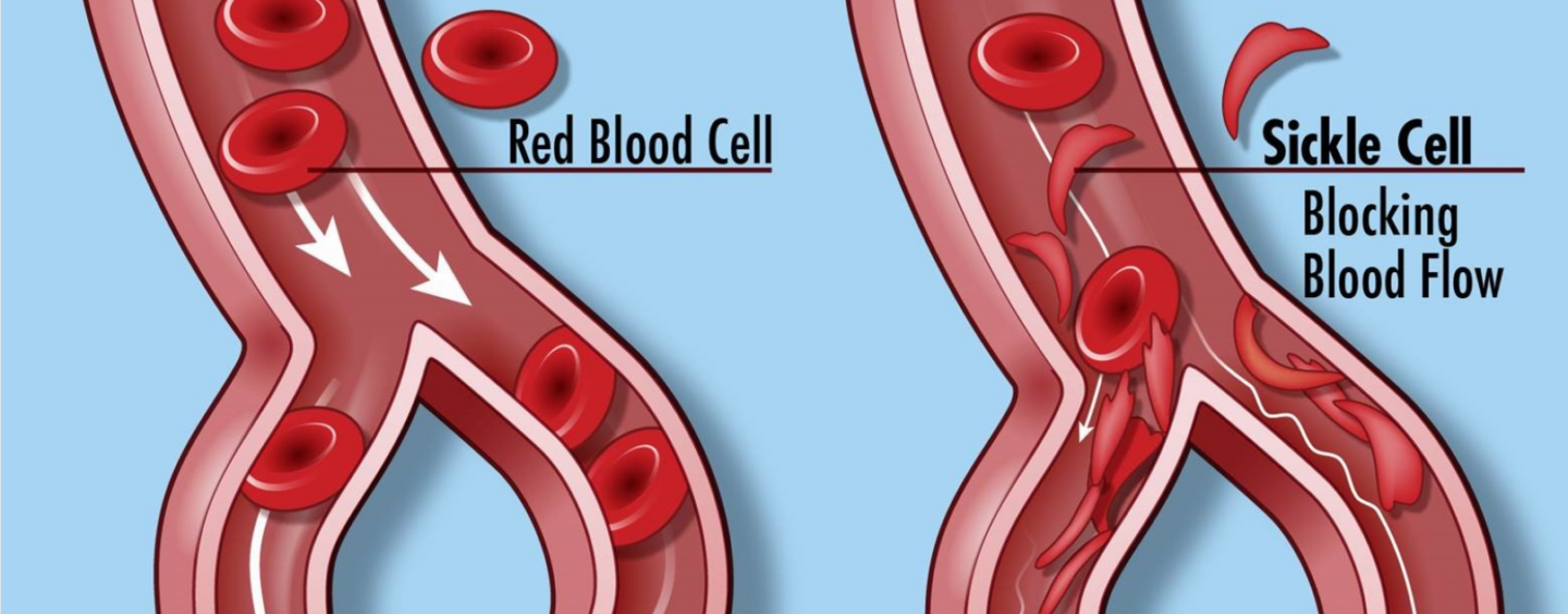 FDA Approves Groundbreaking Cell-Based Gene Therapies for Sickle Cell Disease