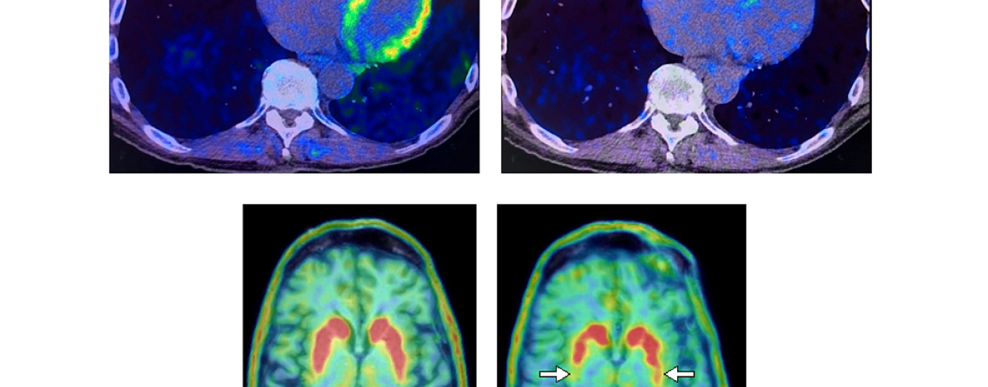 Revolutionary Study Explores Heart PET Scans as Game-Changer for Early Parkinson’s and Lewy Body Dementia Detection