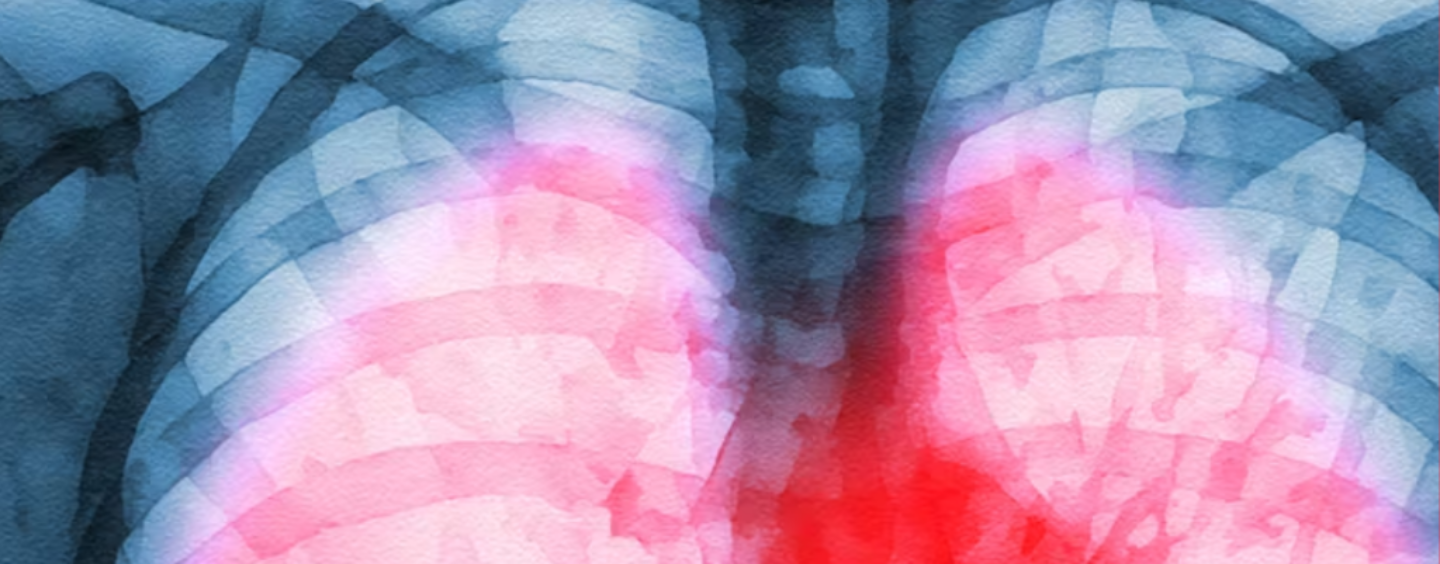 Long COVID Inflicts Deep Scars On the Lungs, But Targeting Specific Immune Cells Could Reverse Damage − New Research in Mice