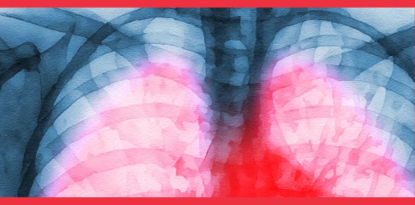 Long COVID Inflicts Deep Scars On the Lungs, But Targeting Specific Immune Cells Could Reverse Damage − New Research in Mice