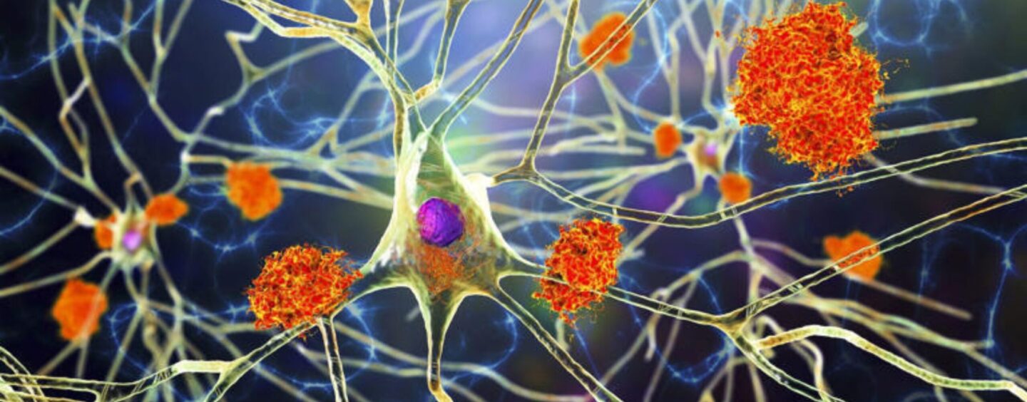 There’s a New Blood Test for Alzheimer’s. Here’s Everything You Need to Know About It.