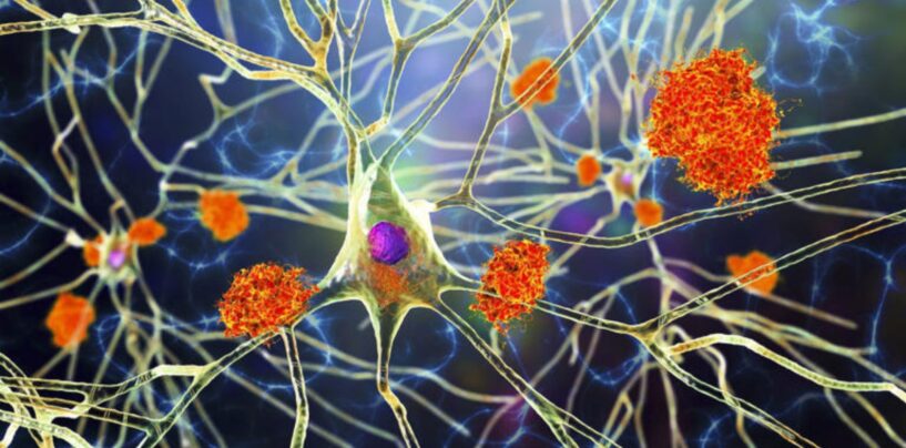 There’s a New Blood Test for Alzheimer’s. Here’s Everything You Need to Know About It.